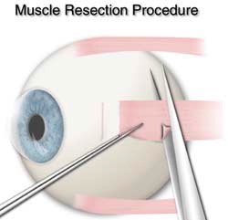 Fig. 2 In a resection procedure a segment of muscle is removed from the extraocular muscle. The shortened extraocular muscle is then reattached