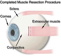Fig. 3 After a resection the extraocular muscle has not changed position as in a recession. The only difference is the shorter length of the extraocular muscle.