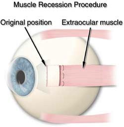 Fig. 1 In a recession procedure the muscle is cut from the surface of the eye and reattached further back from the front of the eye.