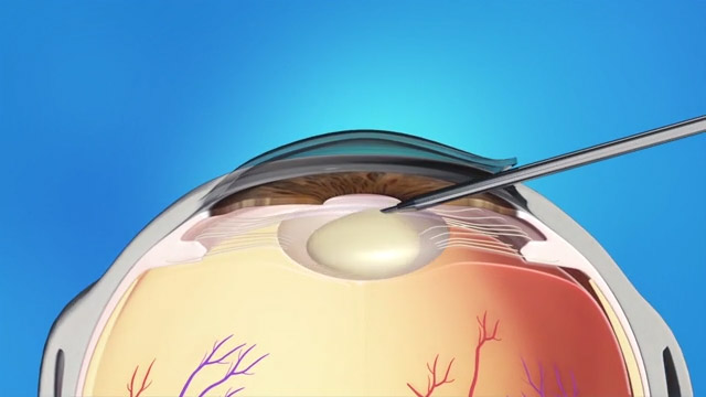 Eye Crossing/Strabismus | Children's Eye Center | El Paso, TX